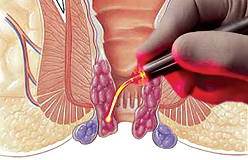 Hemoroidlerde Lazer Tedavisi